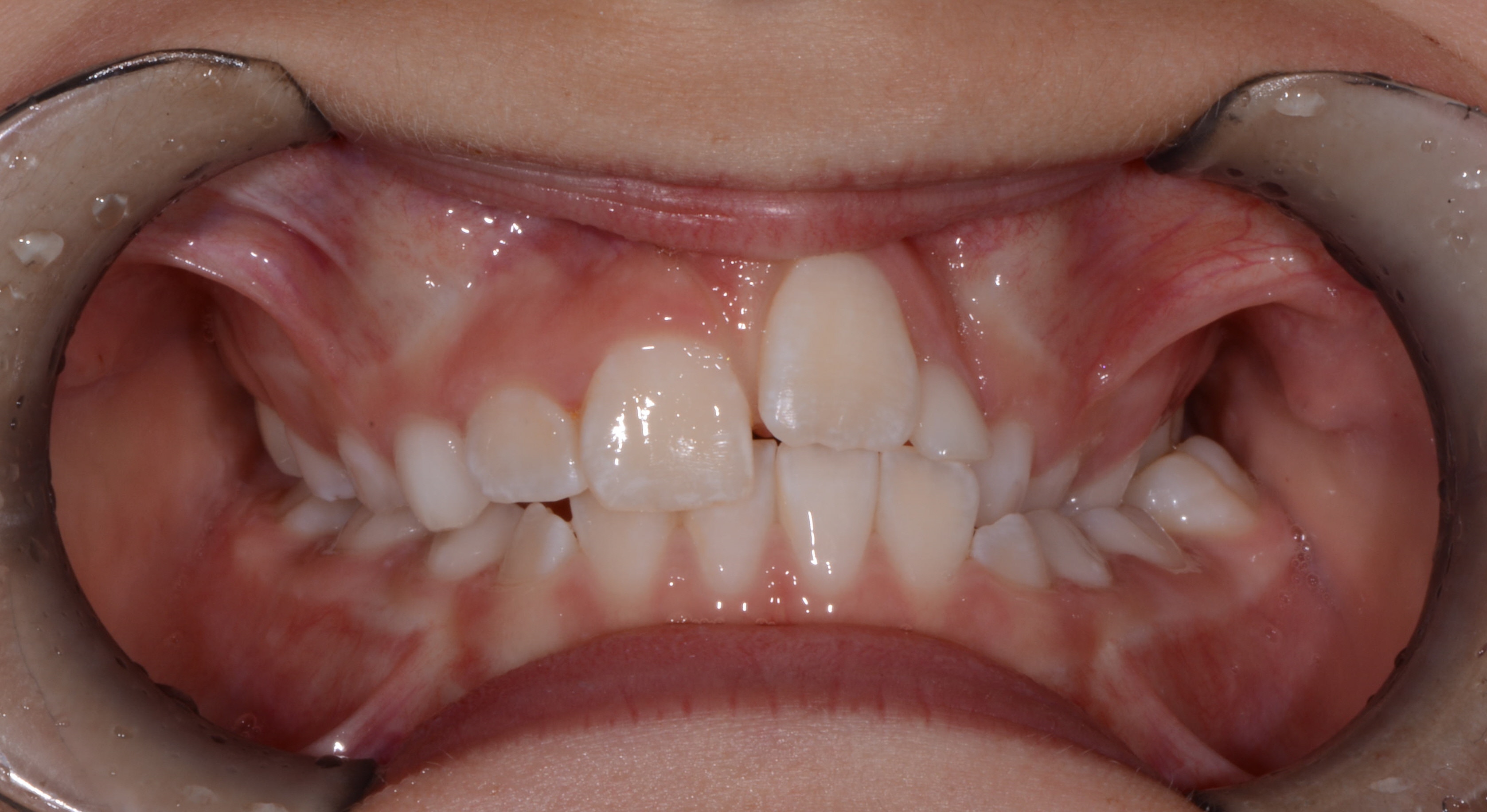 Summer before Phase I treatment - crowded teeth